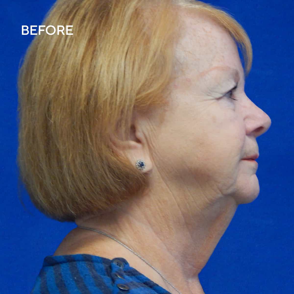 Top Great Neck New York Facelift Surgeon Psny