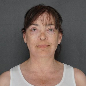 Woman turning 70 facelift neck lift brow lift upper lower blepharoplasty after results - natural youthful transformation Long Island NY – post op poster for testimonial video zoomed in Front version two