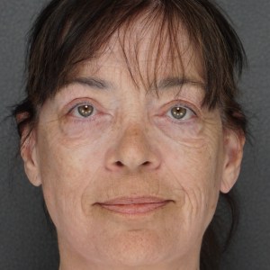 Woman turning 70 facelift neck lift brow lift upper lower blepharoplasty after results - natural youthful transformation Long Island NY – front very zoomed for eyes