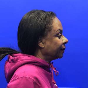 African American middle-aged woman facelift and neck lift natural rejuvenation results – Plastic Surgery of New York