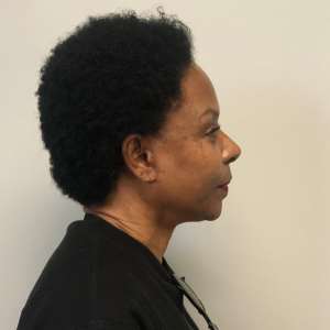Middle-aged African American woman upper eyelid blepharoplasty facelift and neck lift natural rejuvenation results – Plastic Surgery of New York – pre op lateral