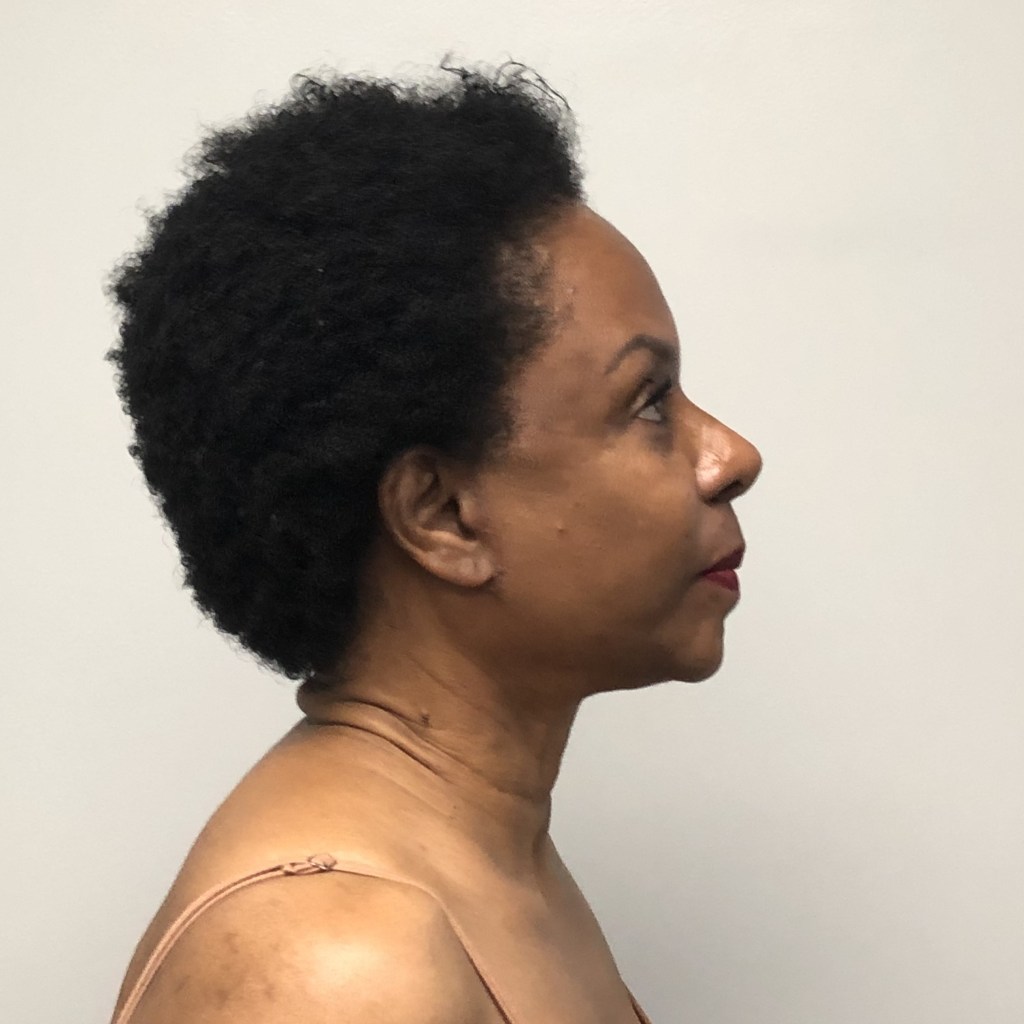 Middle-aged African American woman upper eyelid blepharoplasty facelift and neck lift natural rejuvenation results – Plastic Surgery of New York – post op lateral