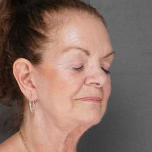 Elderly woman brow lift neck lift upper and lower eyelid blepharoplasty natural rejuvenation results – Plastic Surgery of New York post operative – post op oblique eyes closed