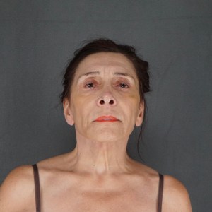 Before photo – 70-year-old woman face and neck lift with natural rejuvenation and minimal scarring – Plastic Surgery of New York – front zoom out