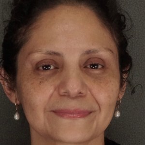 Middle-aged woman brow lift upper and lower eyelid blepharoplasty natural rejuvenation results – Plastic Surgery of New York before and after photo – pre op no smile pre op