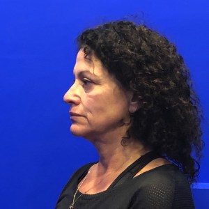 Middle-aged woman facelift natural beautiful results hidden scars – Dr. Elkowitz Great Neck New York City Plastic Surgery of New York preoperative before and after photo – pre op oblique