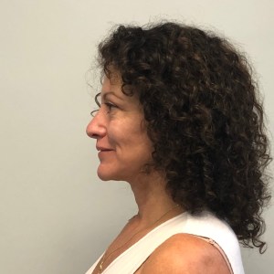 Middle-aged woman facelift natural beautiful results hidden scars – Dr. Elkowitz Great Neck New York City Plastic Surgery of New York postoperative before and after photo – post op lateral