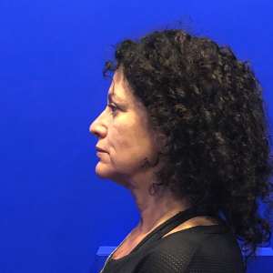 Middle-aged woman facelift natural beautiful results hidden scars – Dr. Elkowitz Great Neck New York City Plastic Surgery of New York preoperative before and after photo – pre op lateral