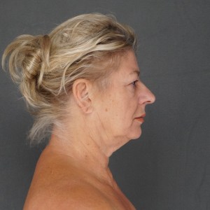Female patient facial rejuvenation facelift neck lift upper lower eyelid surgery brow lift before photo - Plastic Surgery of New York – lateral post op zoom out