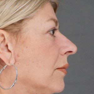 Middle aged woman facelift neck lift brow lift upper lower blepharoplasty after results - natural facial rejuvenation Great Neck NY – post op side zoom out