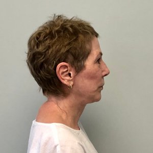 Elderly woman facelift neck lift eyelid surgery significant jowling correction natural beautiful rejuvenation results – Plastic Surgery of New York pre-op – post op lateral
