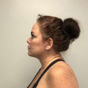 post operative Young woman neck lift after massive GLP-1 weight loss natural contouring results – Plastic Surgery of New York