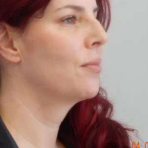 Young woman neck liposuction natural contouring results – Plastic Surgery of New York pre operative