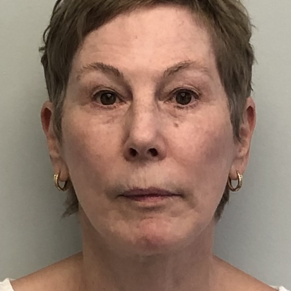 natural, refreshed results for the face, eyes, and neck facelift neck lift