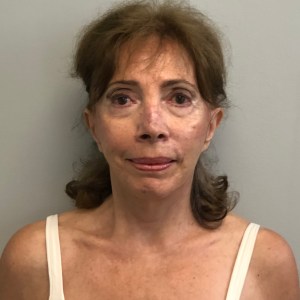 80-year-old woman facelift, neck lift, and eyelid surgery – refreshed natural results for the face, eyes, and neck – Plastic Surgery of New York post operative after – front