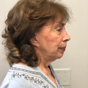 Подтяжка лица, шеи и блефаропластика у 80-летней женщины — естественный омолаживающий результат для лица, глаз и шеи — Пластическая хирургия Нью-Йорка, до операции — вид сбоку