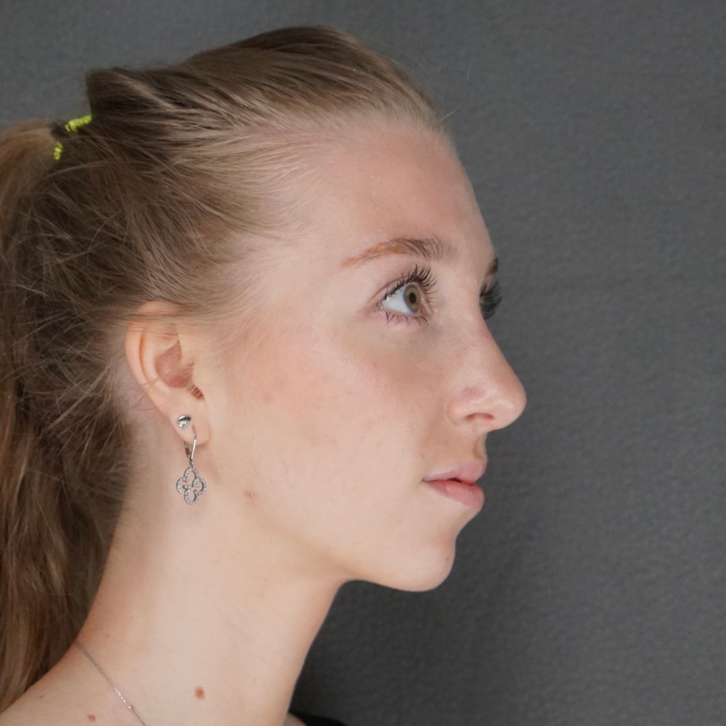 nose job, rhinoplasty, nasal dorsum, bump, nasal tip