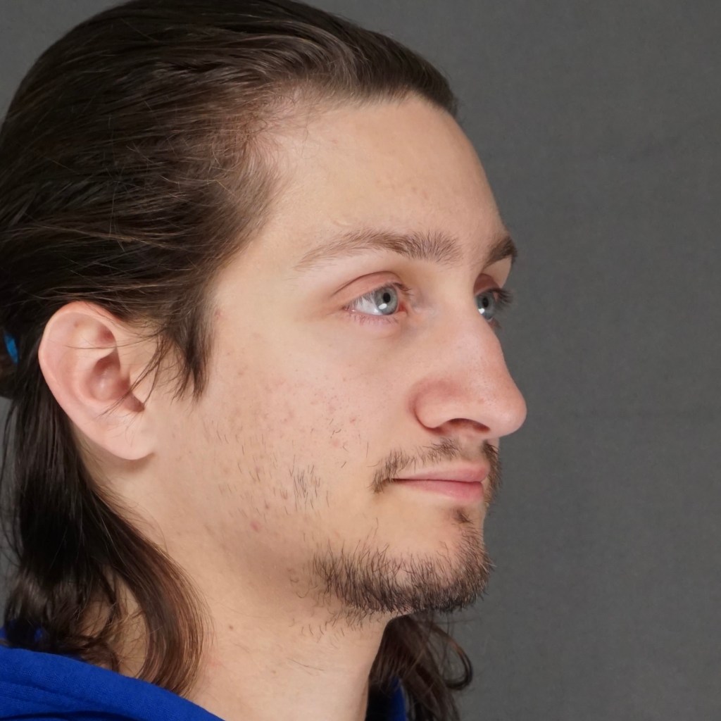 nose job, rhinoplasty, nasal dorsum, bump, nasal tip