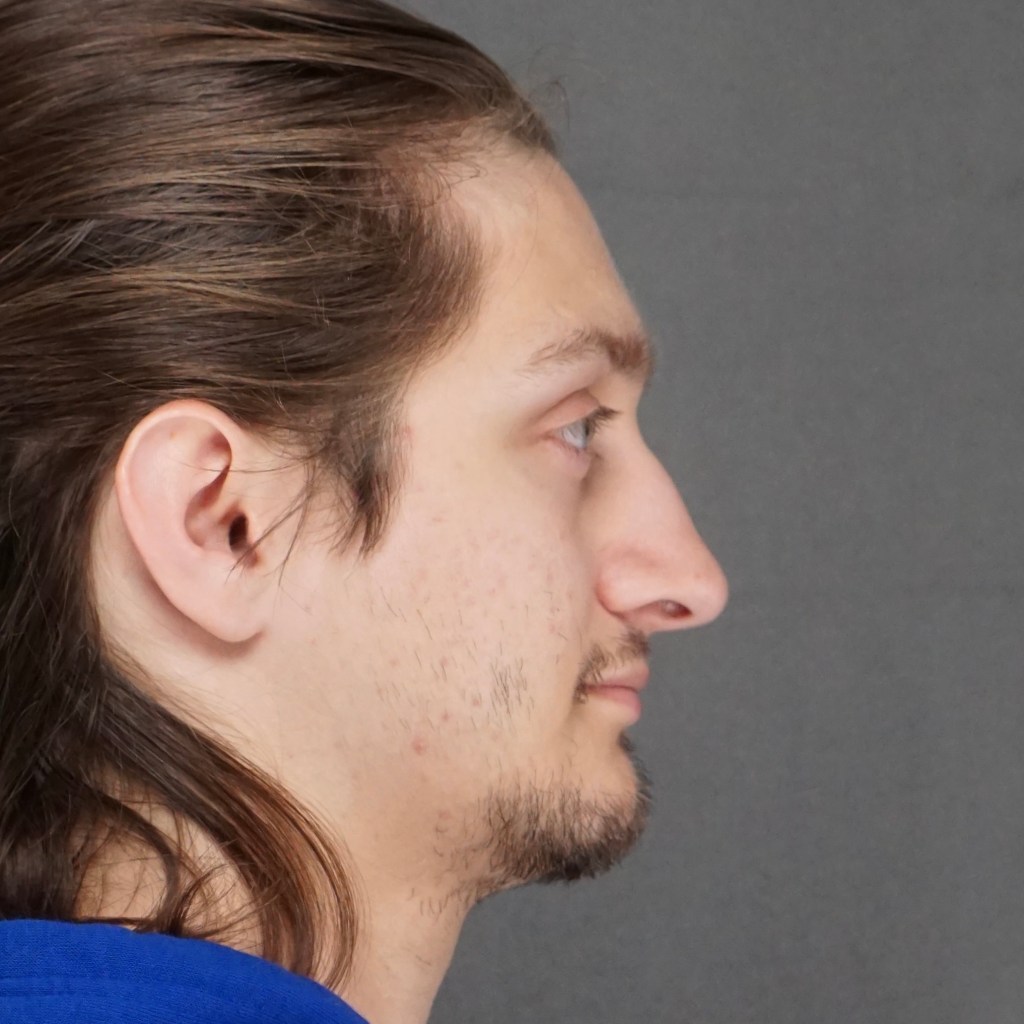 nose job, rhinoplasty, nasal dorsum, bump, nasal tip