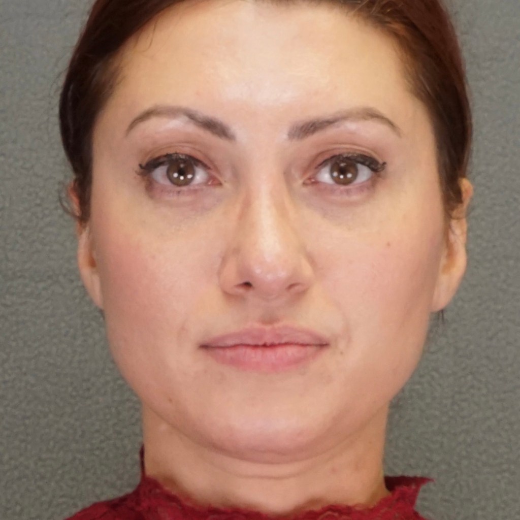 natural, refreshed results for the face, eyes, and neck facelift neck lift before and after