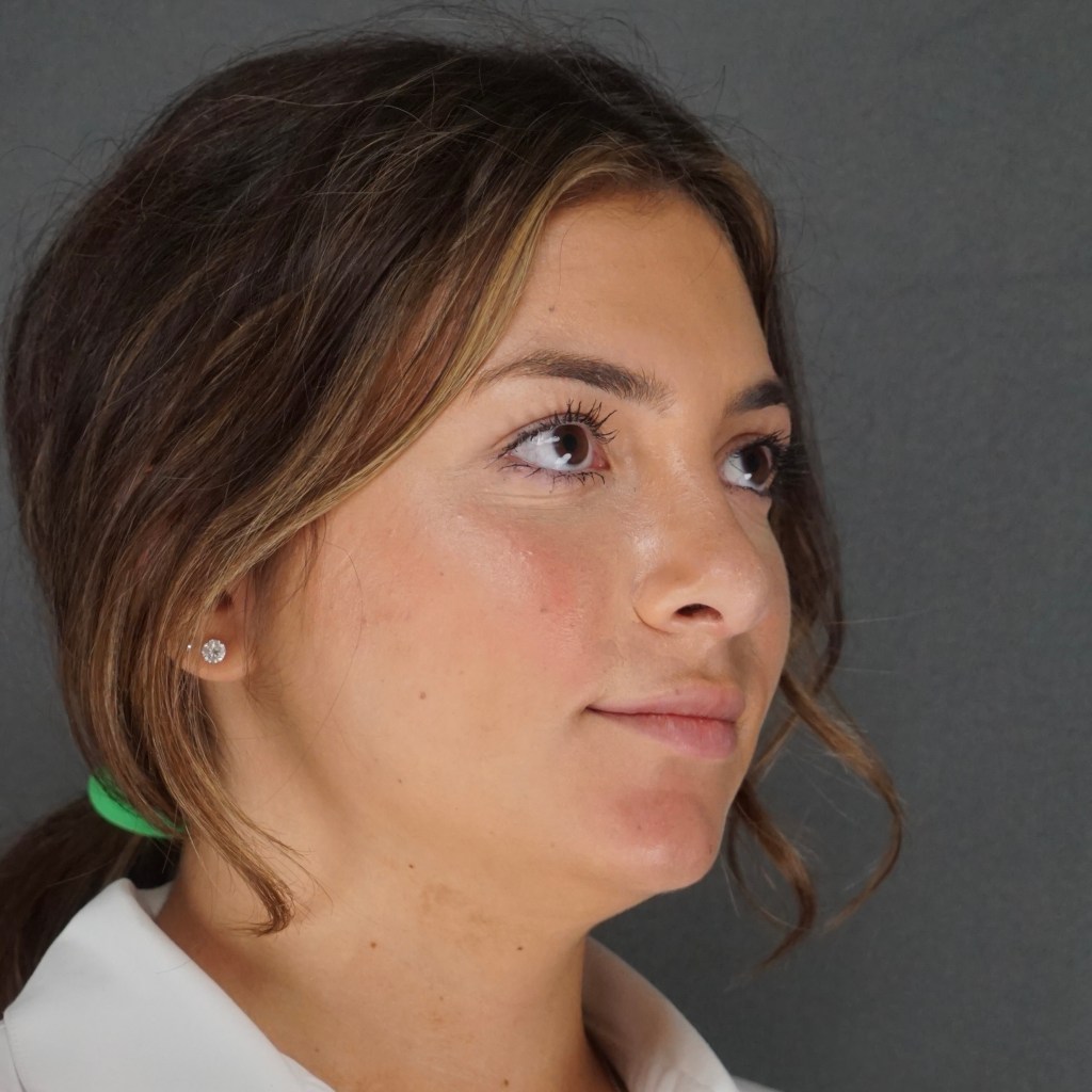 nose job, rhinoplasty, nasal dorsum, bump, nasal tip