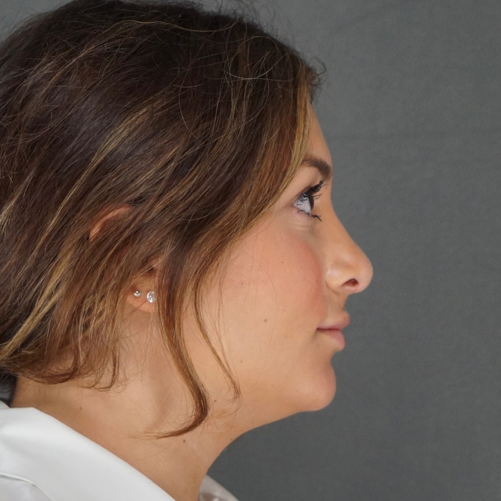 nose job, rhinoplasty, nasal dorsum, bump, nasal tip