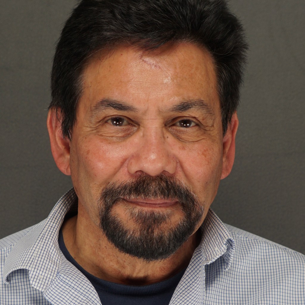 nose job, rhinoplasty, nasal dorsum, bump, nasal tip