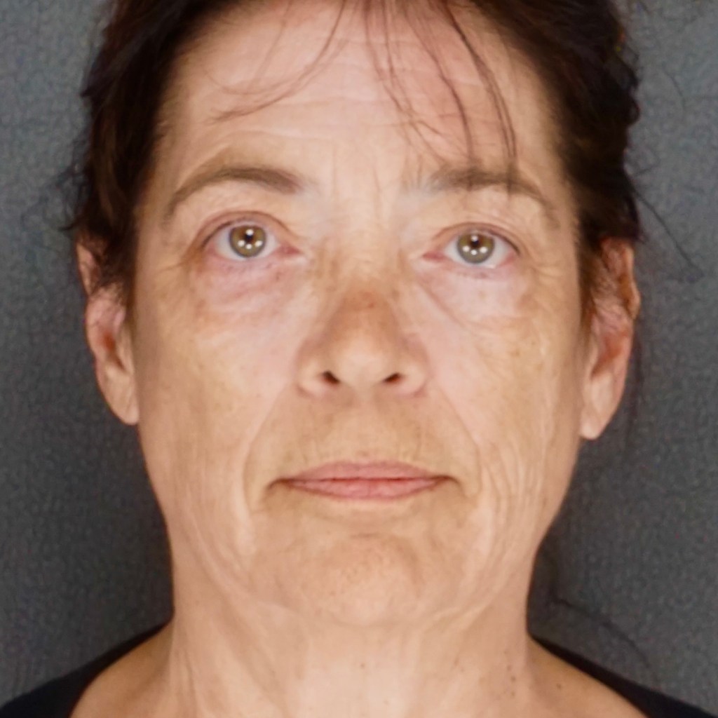 natural, refreshed results for the face, eyes, and neck facelift neck lift before and after