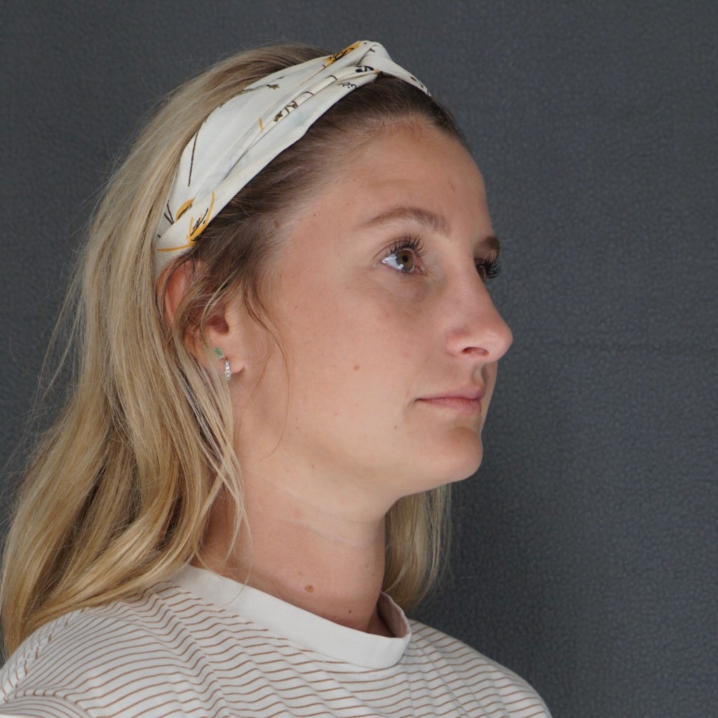 nose job, rhinoplasty, nasal dorsum, bump, nasal tip