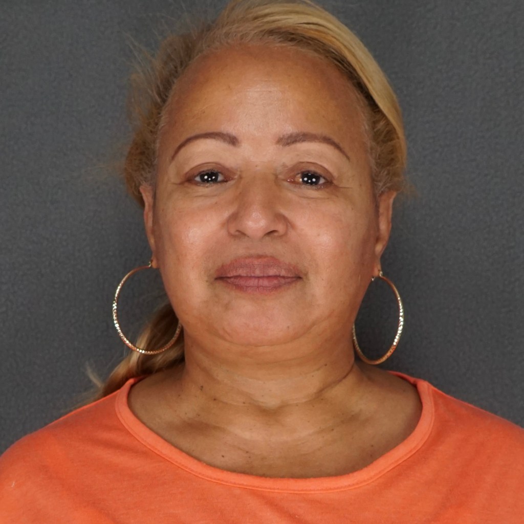 natural, refreshed results for the face, eyes, and neck facelift neck lift before and after