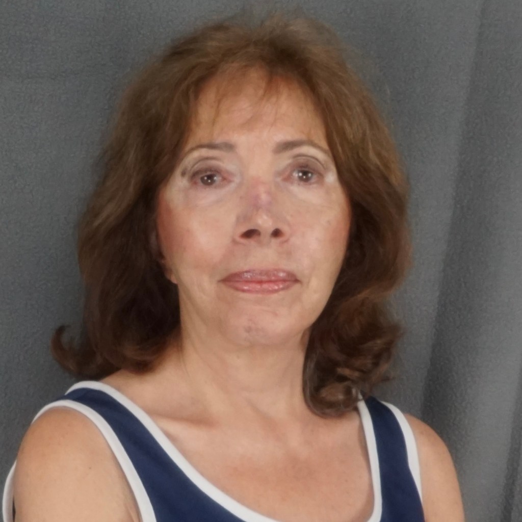 natural, refreshed results for the face, eyes, and neck facelift neck lift before and after
