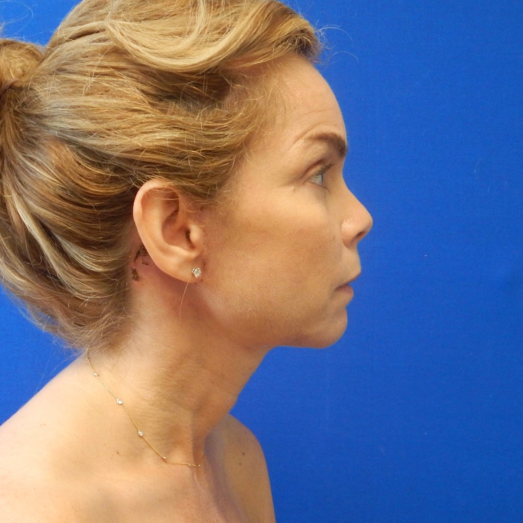 natural, refreshed results for the face, eyes, and neck facelift neck lift before and after