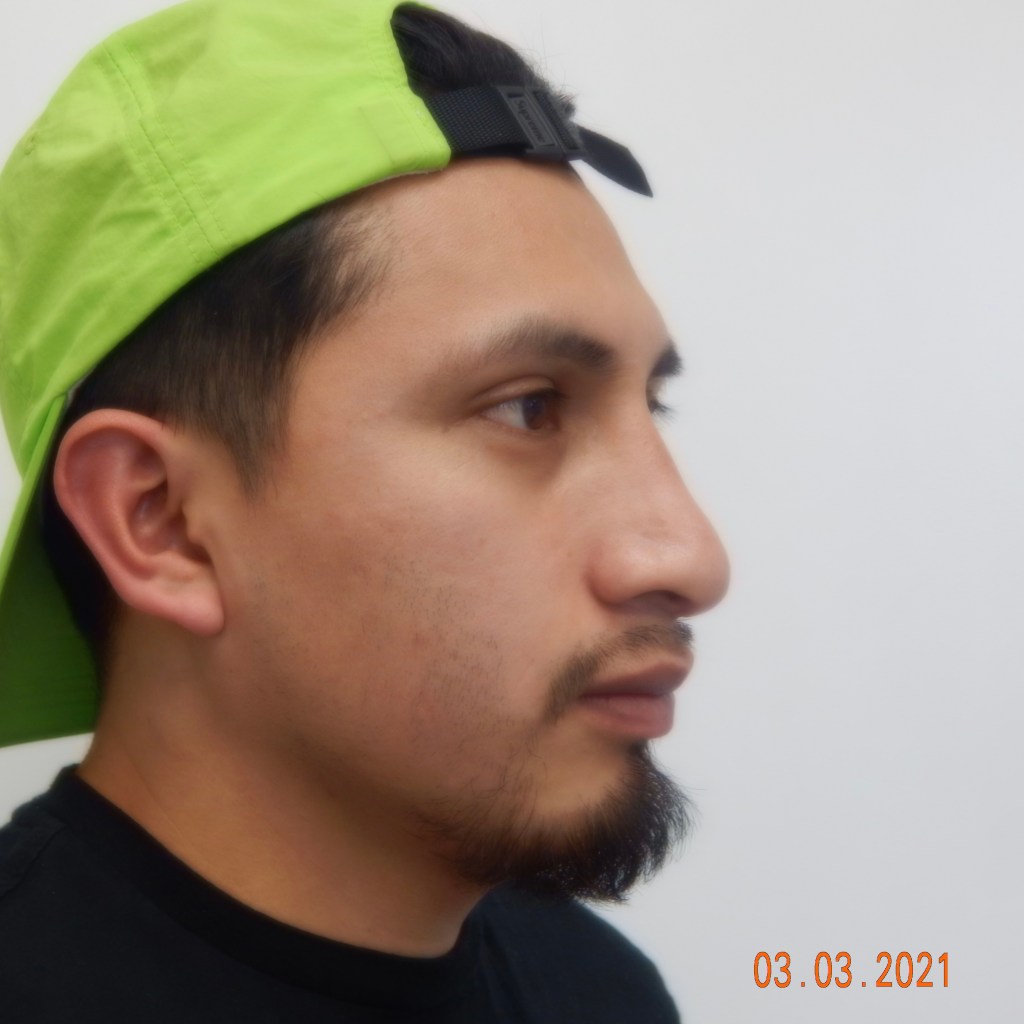 nose job, rhinoplasty, nasal dorsum, bump, nasal tip, male rhinoplasty before and after