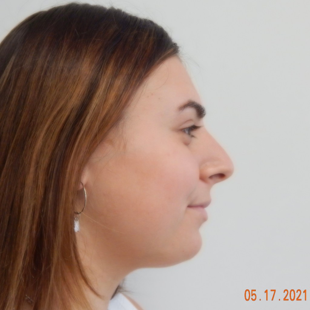 nose job, rhinoplasty, nasal dorsum, bump, nasal tip