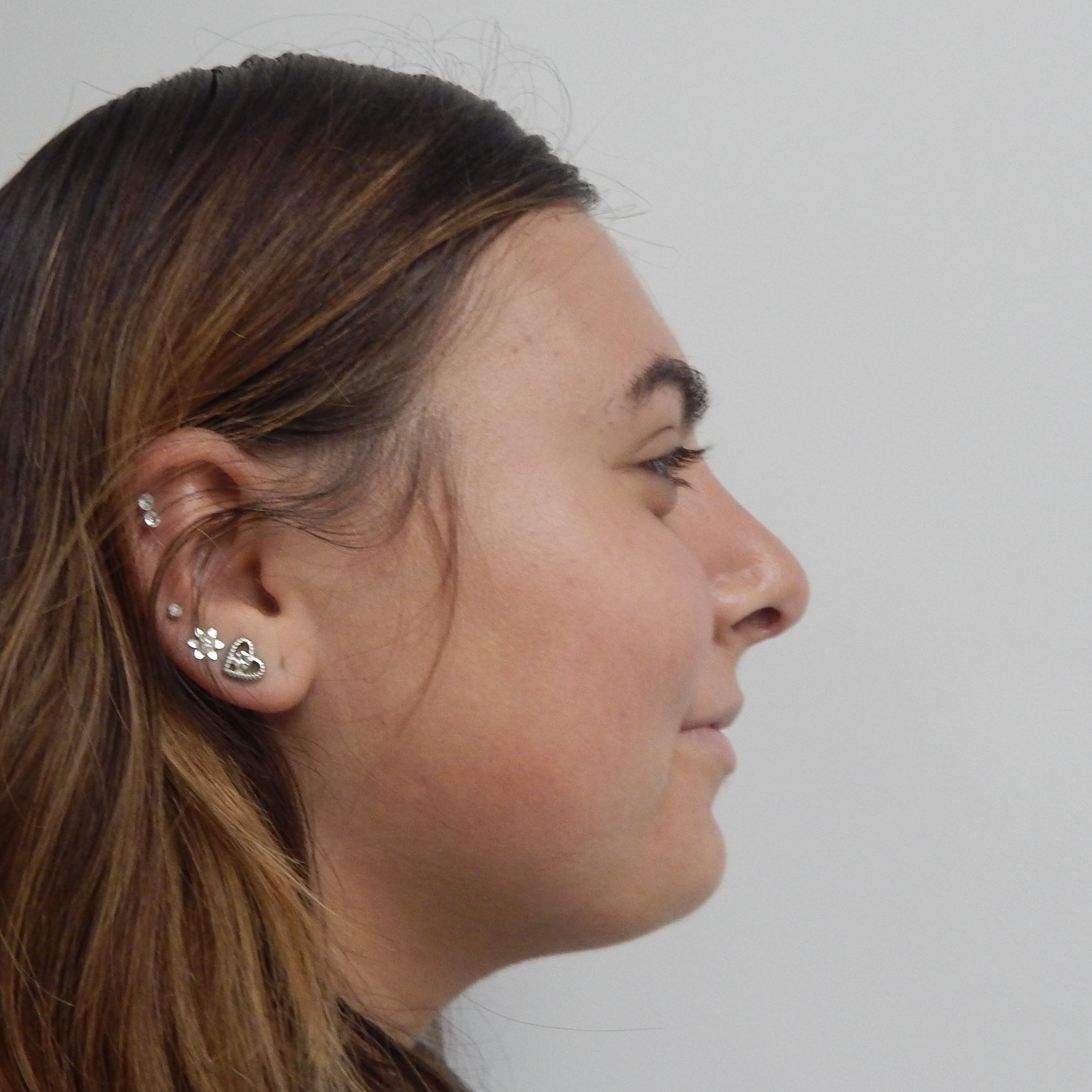 nose job, rhinoplasty, nasal dorsum, bump, nasal tip before and after