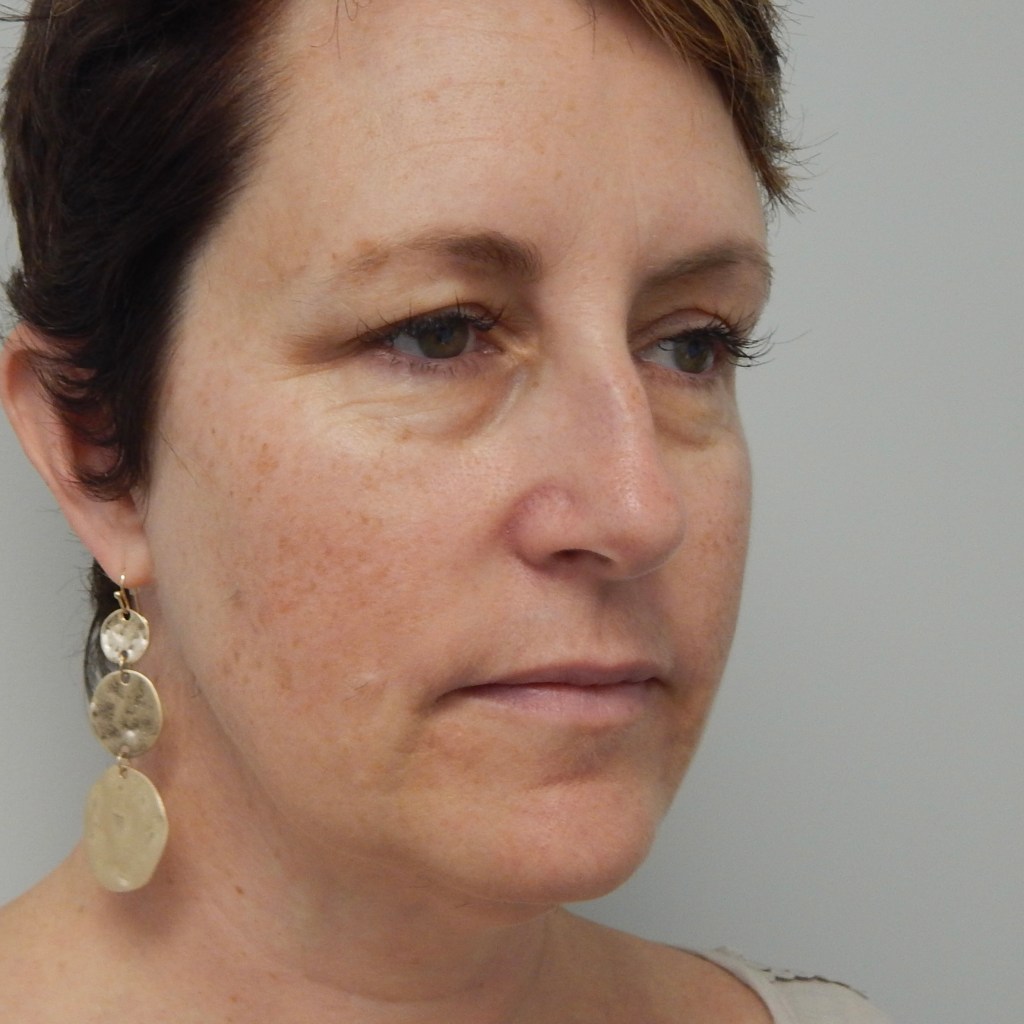 natural, refreshed results for the face, eyes, and neck facelift neck lift before and after