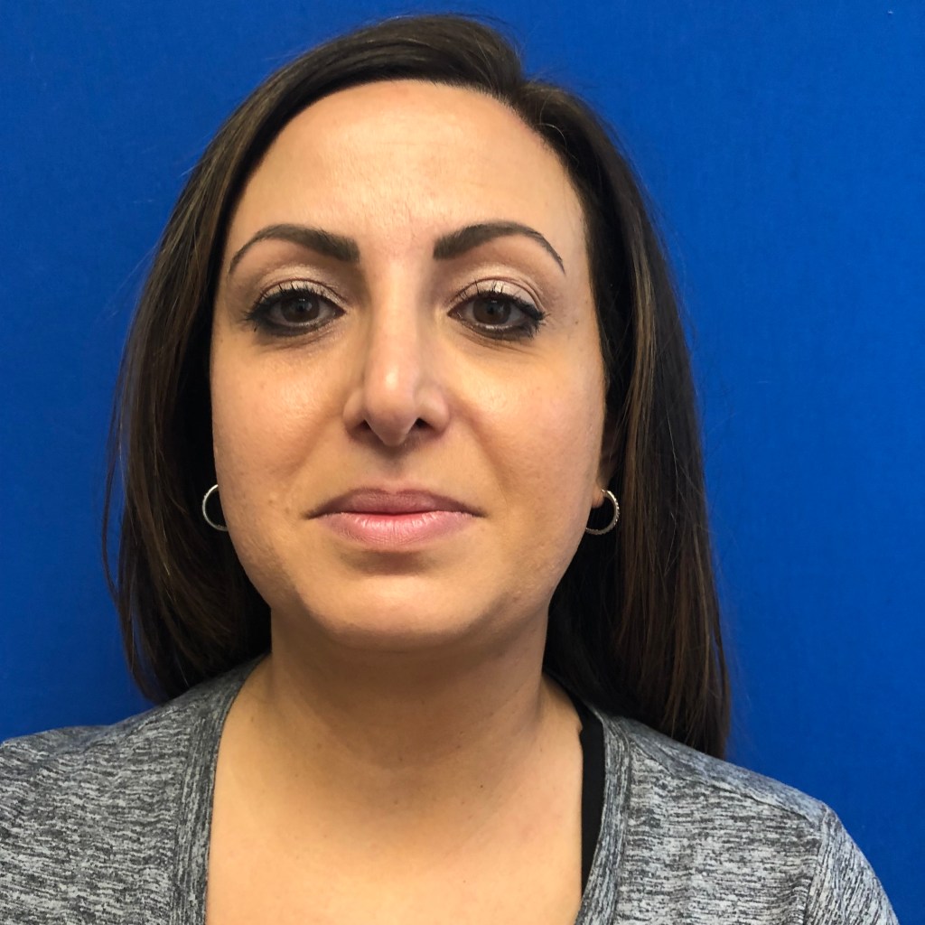 neck liposuction before and after