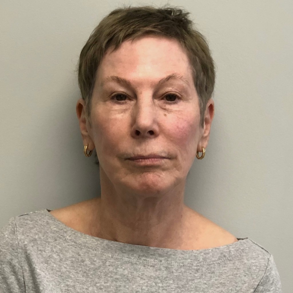 natural, refreshed results for the face, eyes, and neck facelift neck lift before and after