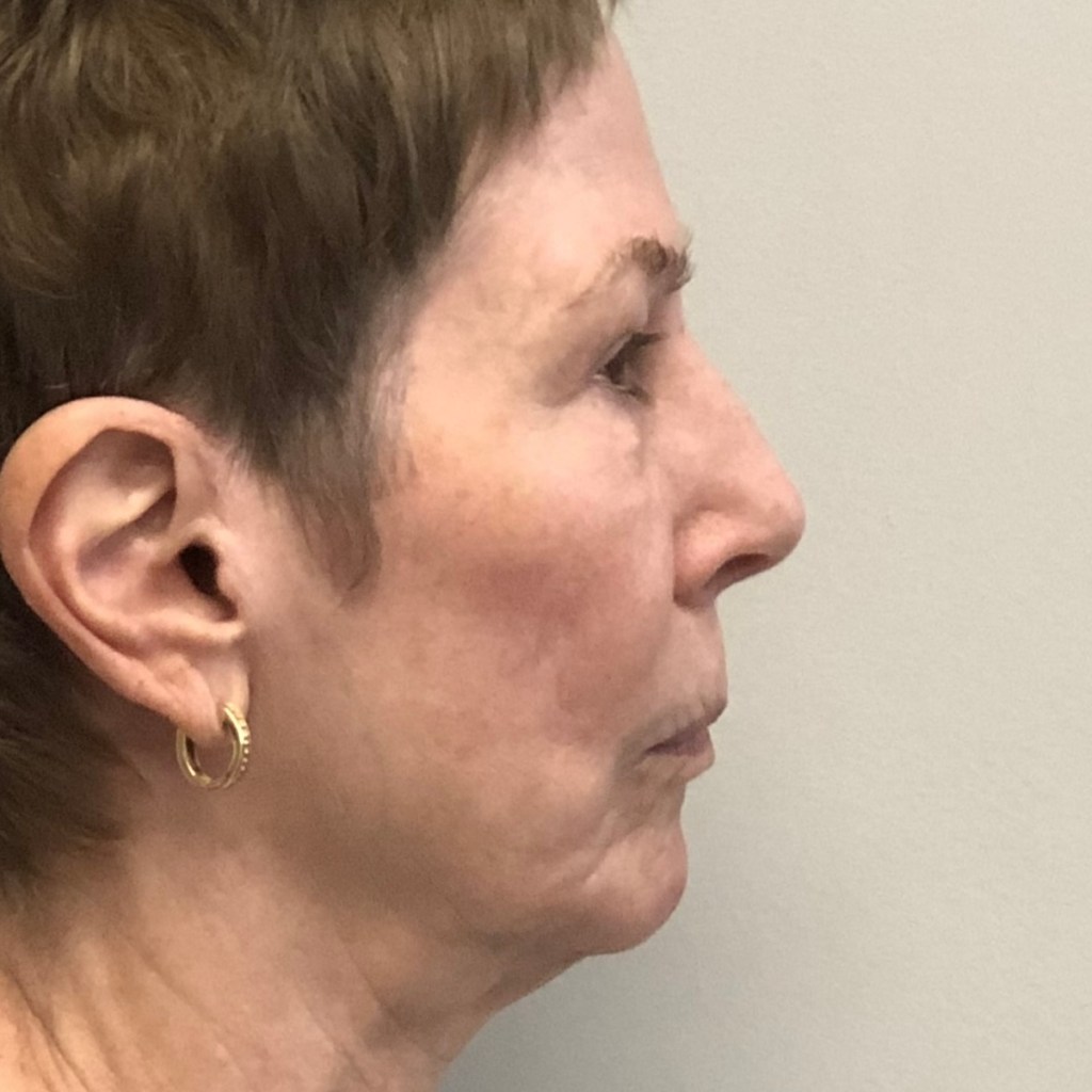 natural, refreshed results for the face, eyes, and neck facelift neck lift