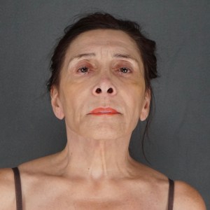 before photo – 70-year-old woman face and neck lift with natural rejuvenation and minimal scarring – Plastic Surgery of New York – front zoom in