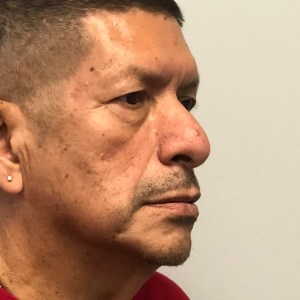 Middle-aged man upper and lower eyelid blepharoplasty natural rejuvenation results – Plastic Surgery of New York – pre op zoom in oblique