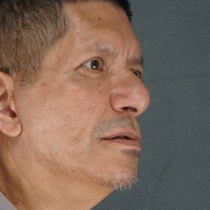 Middle-aged man upper and lower eyelid blepharoplasty natural rejuvenation results – Plastic Surgery of New York – oblique pre op zoom in