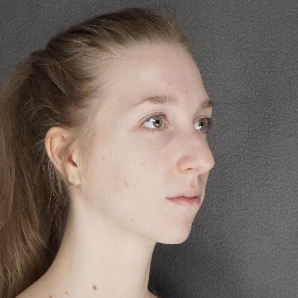 Résultat d'une rhinoplastie naturelle personnalisée montrant la suppression de la bosse du dos du nez et une pointe nasale affinée par le Dr Elkowitz, Plastic Surgery of New York – Rhinoplastie naturelle et esthétique, vue oblique préopératoire
