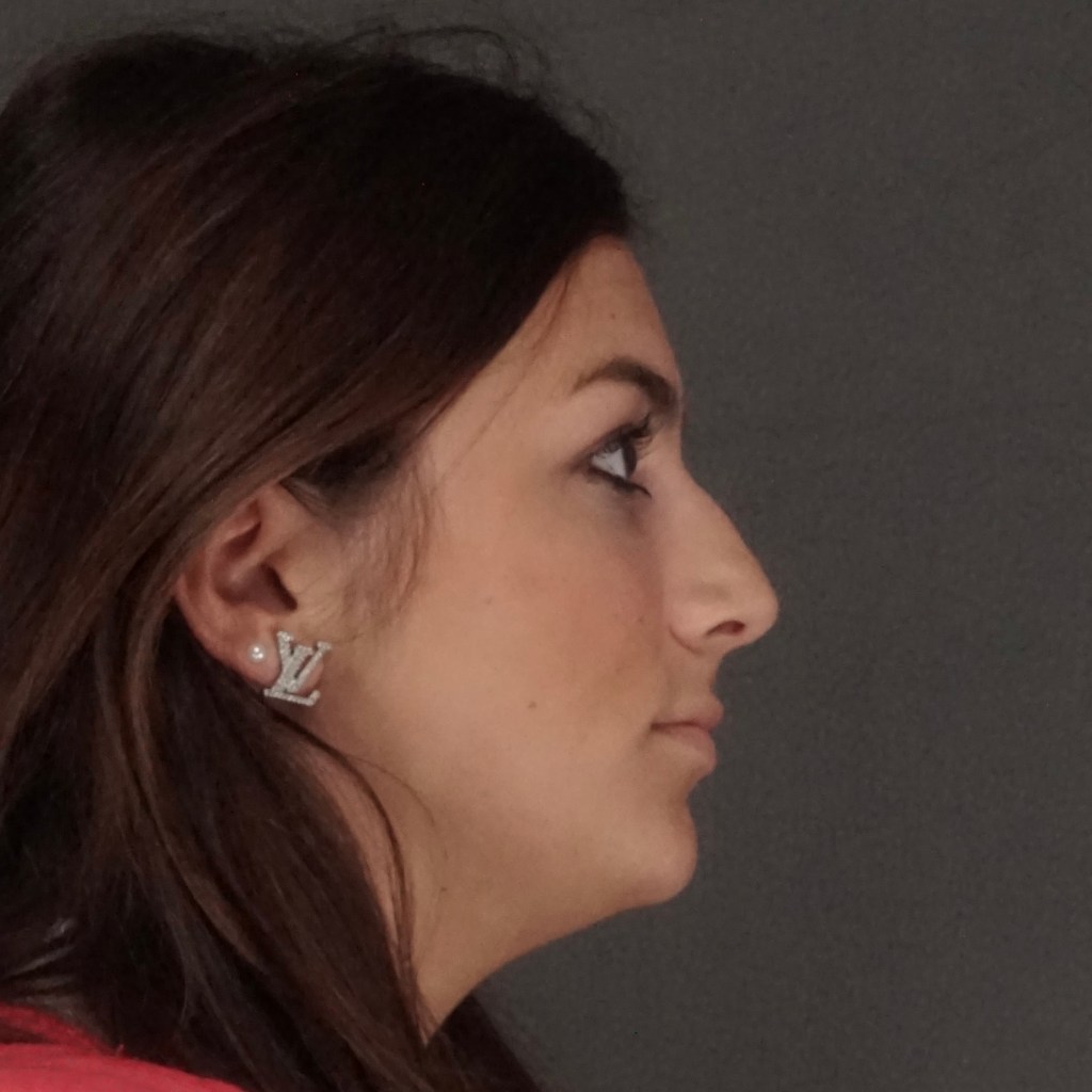 Lateral profile before photo of rhinoplasty patient showing nasal dorsum bump prior to nose job surgery by Dr. Elkowitz, Plastic Surgery of New York