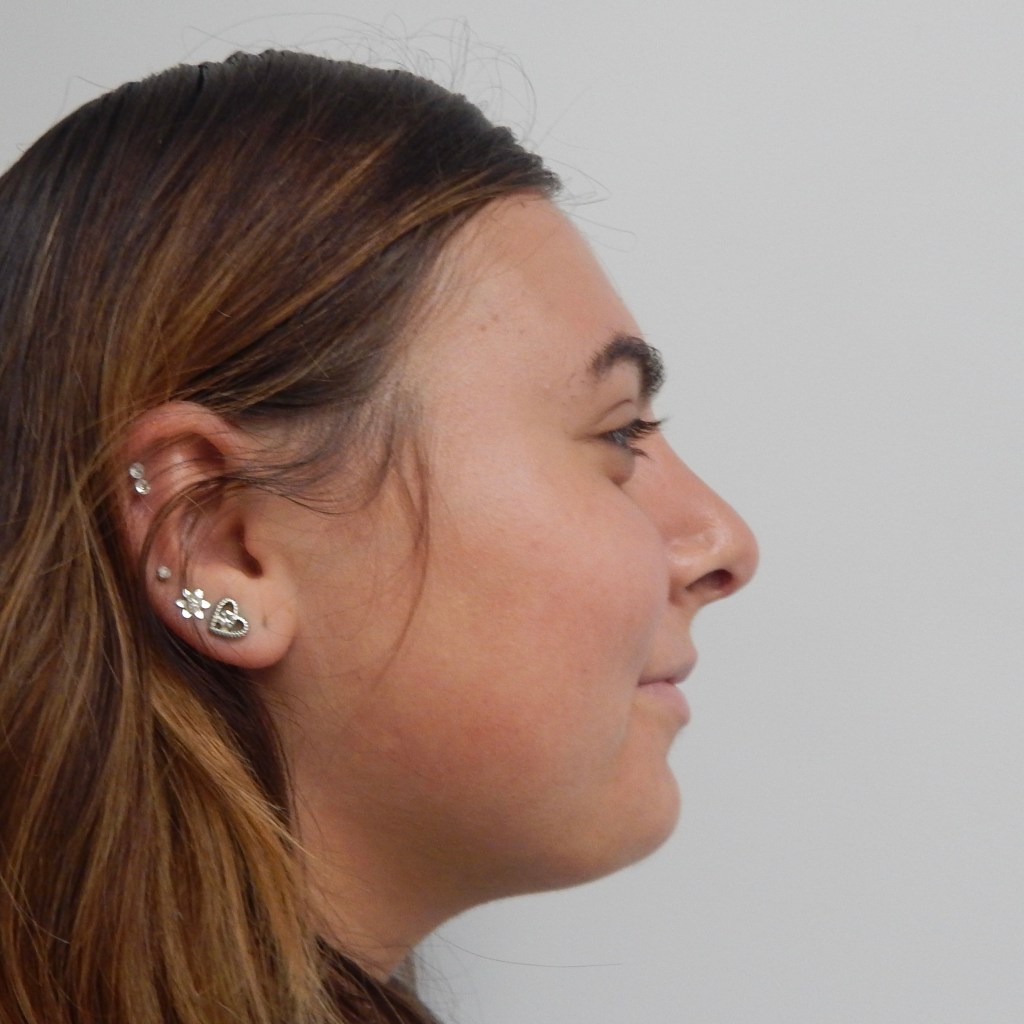 Side profile view after rhinoplasty showing a smooth, refined nasal dorsum — nose job results by Dr. Elkowitz, Plastic Surgery of New York