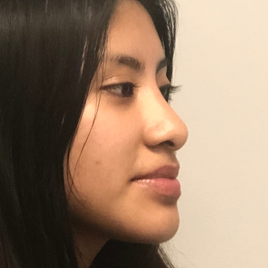 Oblique view of rhinoplasty patient showing dorsal hump correction and nasal tip refinement