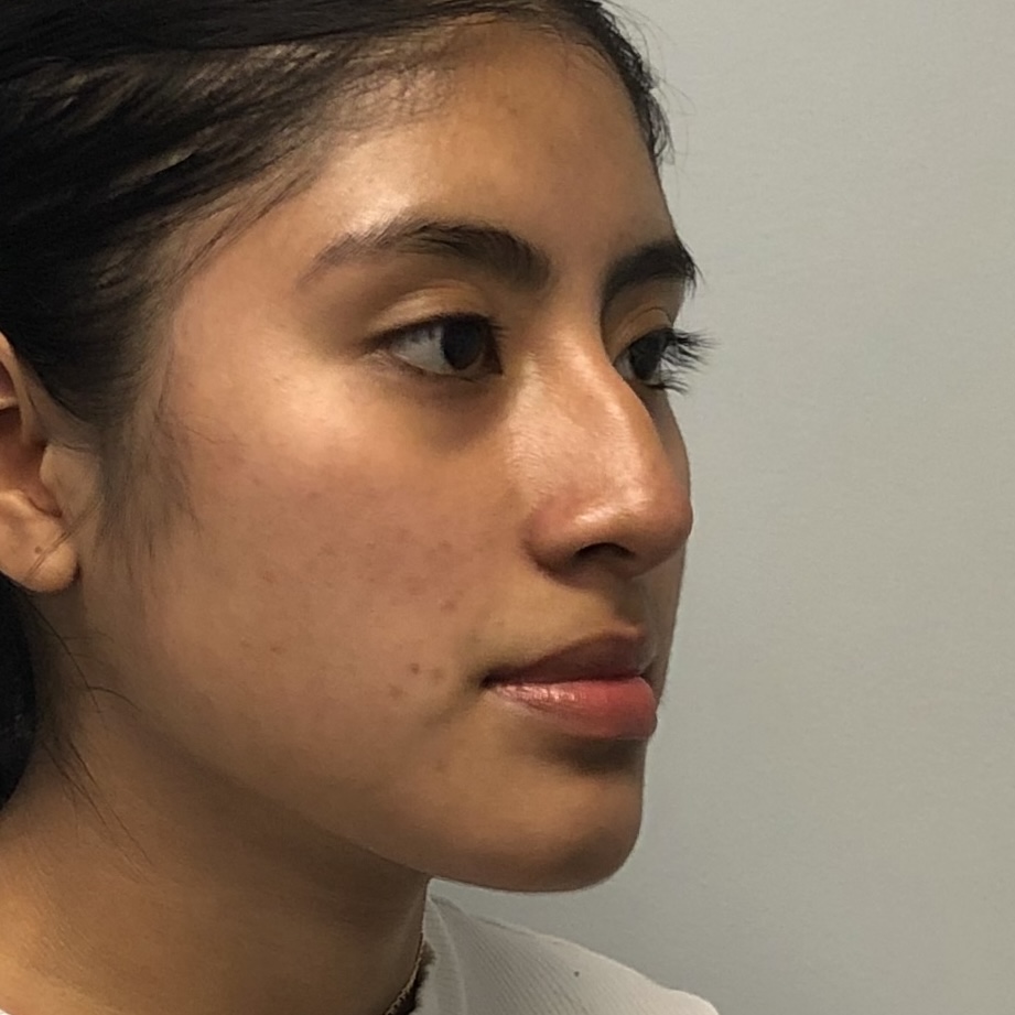 Before and after rhinoplasty showing nasal dorsum bump correction and natural nose profile results by Dr. Elkowitz, Plastic Surgery of New York