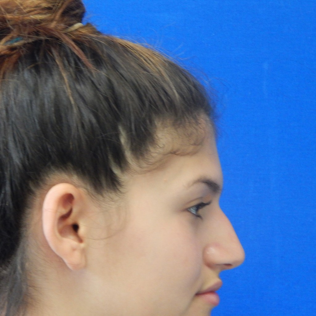 Female patient lateral profile before rhinoplasty showing nasal dorsum bump and nasal tip, Dr. Elkowitz Plastic Surgery of New York