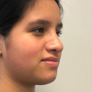 Oblique after view of rhinoplasty patient showing nasal dorsum bump removal and refined tip by Dr. Elkowitz, Plastic Surgery of New York – Nasal tip improvement