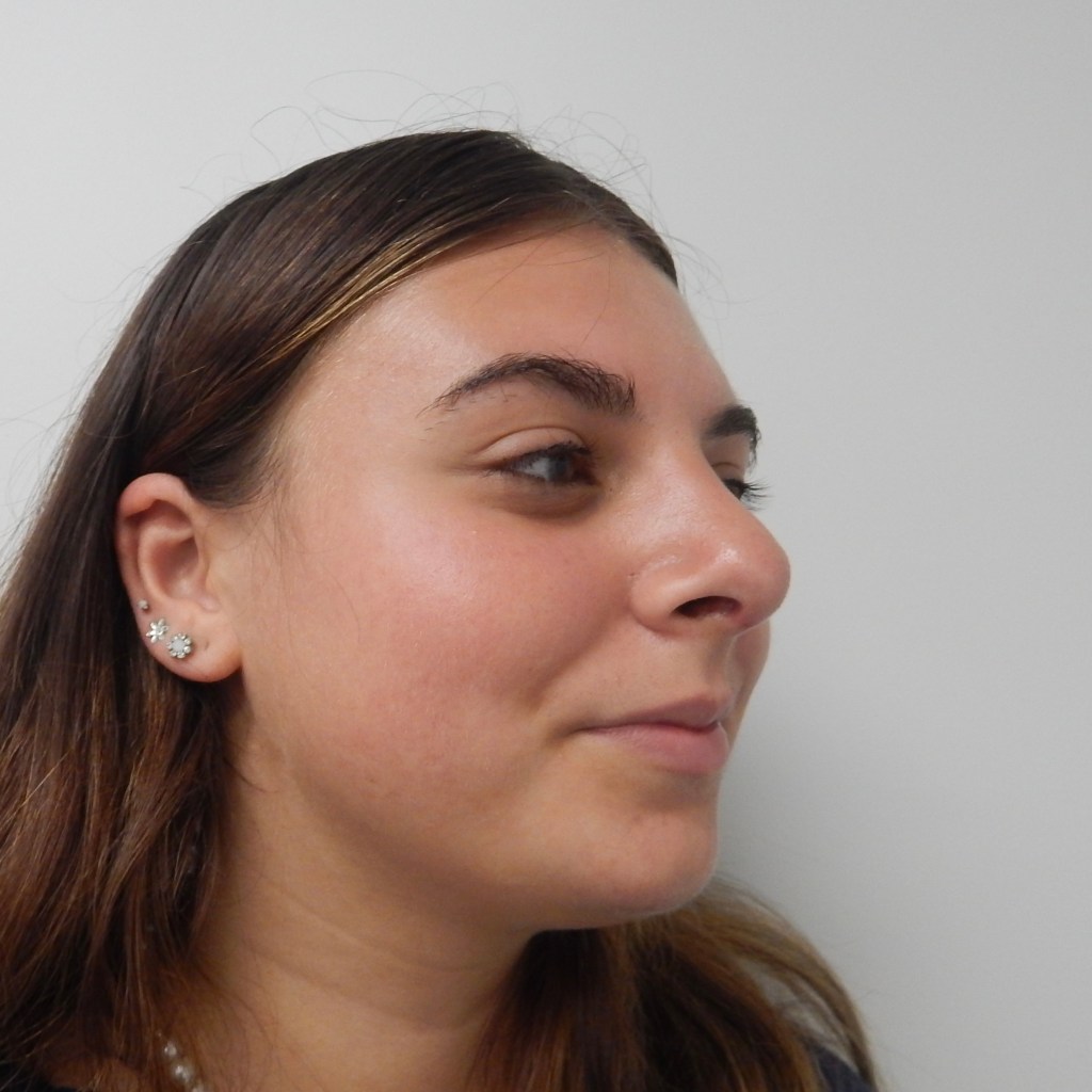 Oblique view after rhinoplasty showing a smooth nasal dorsum, performed by Dr. Elkowitz at Plastic Surgery of New York